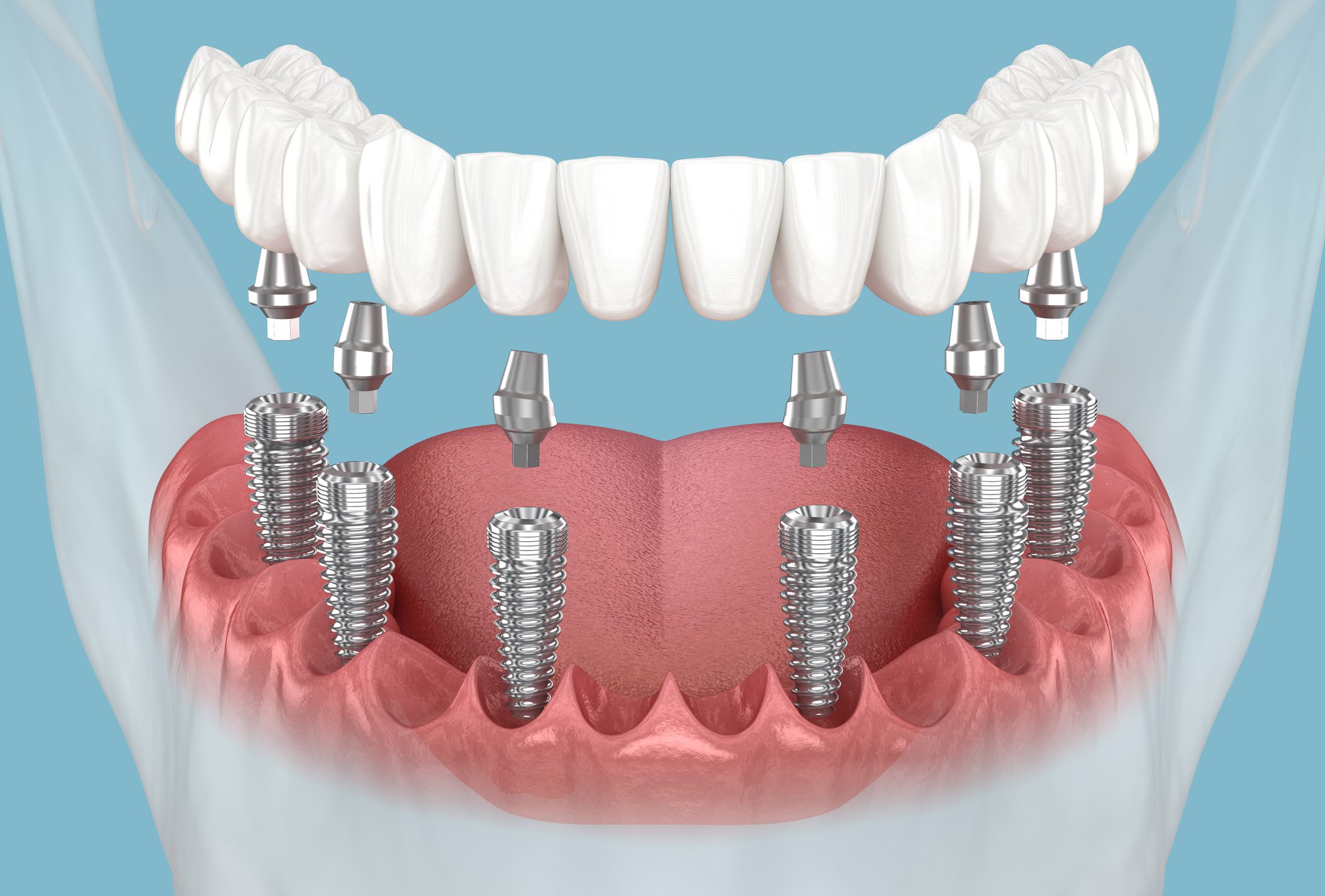 Dental implants and prosthetic teeth illustration