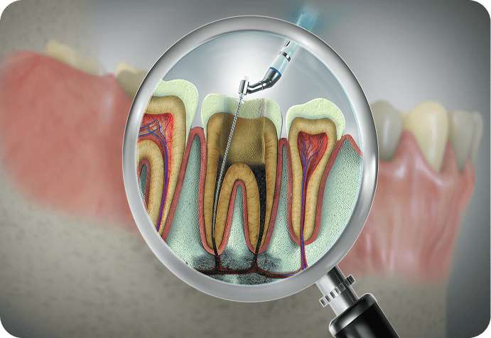Magnified view of dental canal treatment
