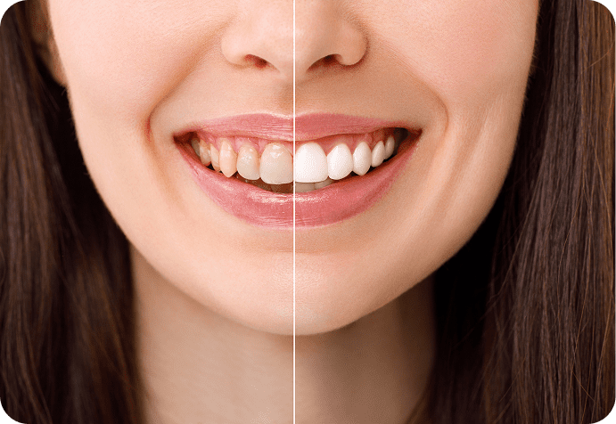 Dental improvement shown in smiling face