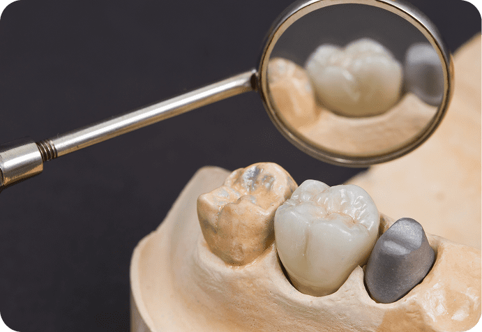 Teeth model showing dental work details