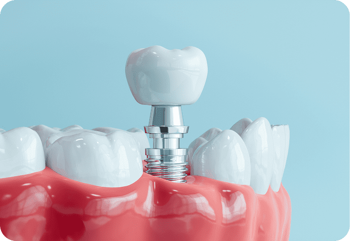 Dental implant illustration with crown